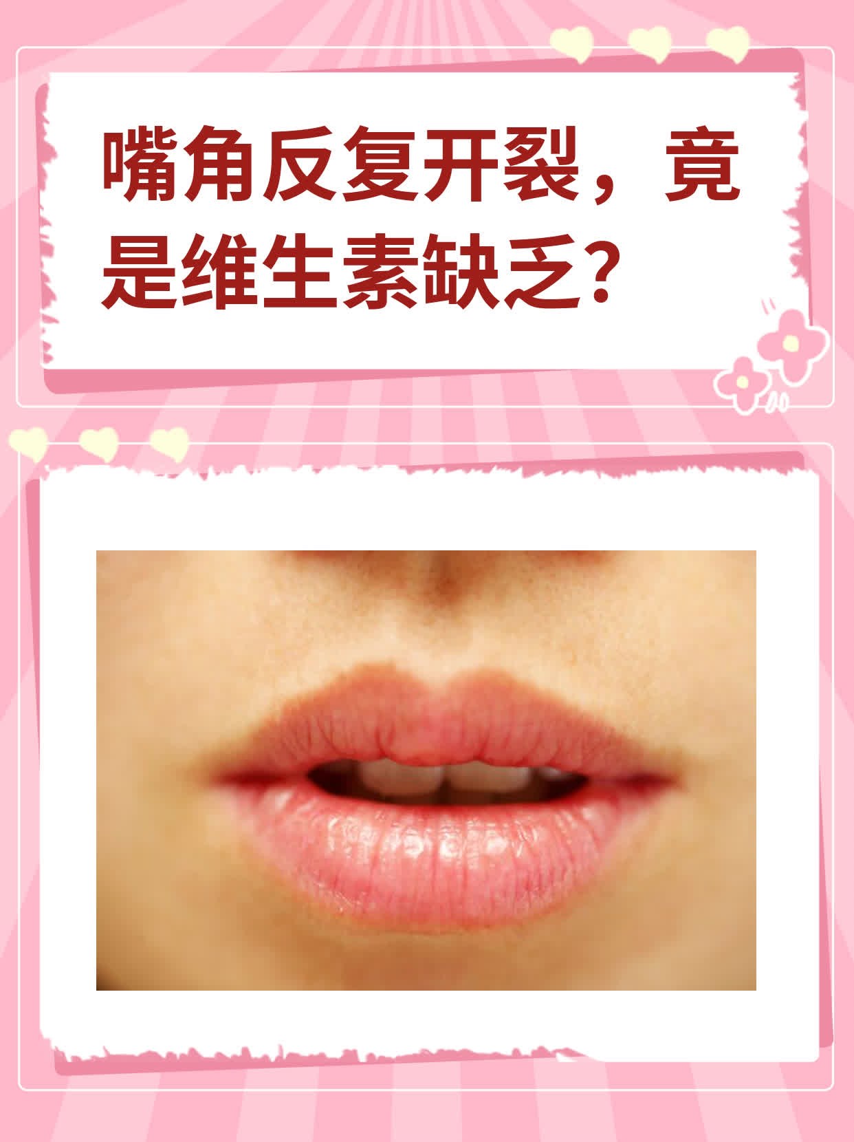 嘴角反复开裂,竟是维生素缺乏