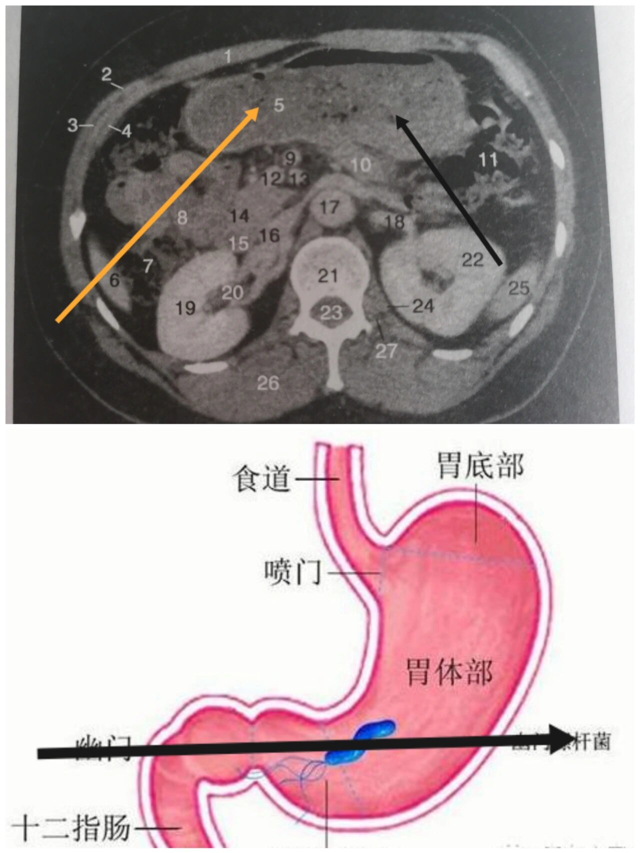 胃的CT横断面解剖