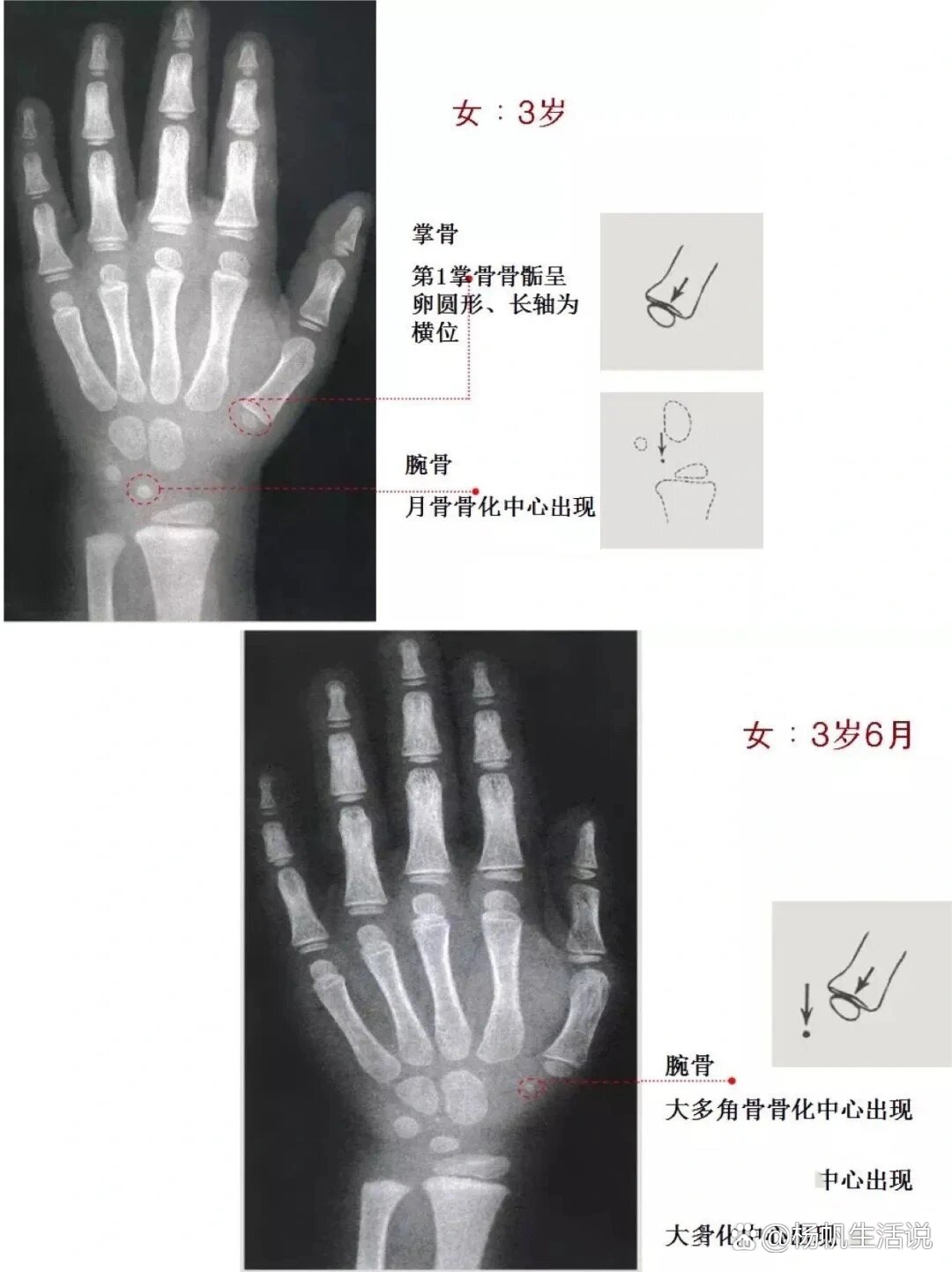 女童骨龄图谱