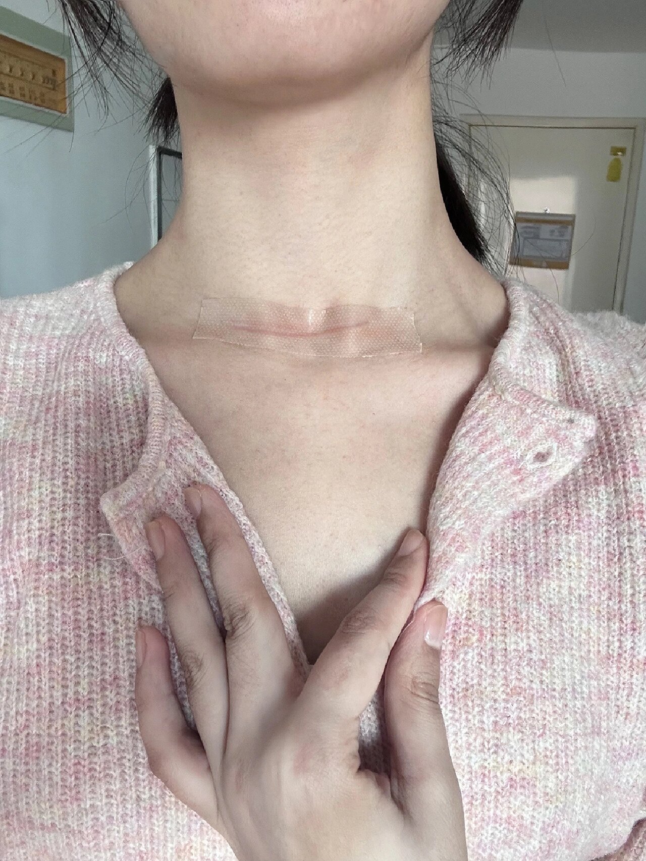 甲状腺手术已经过去半年了,先说一下我的情况:半切,清扫淋巴,伤口