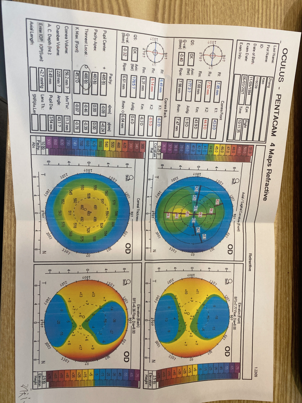 真的有人角膜厚度只有480?