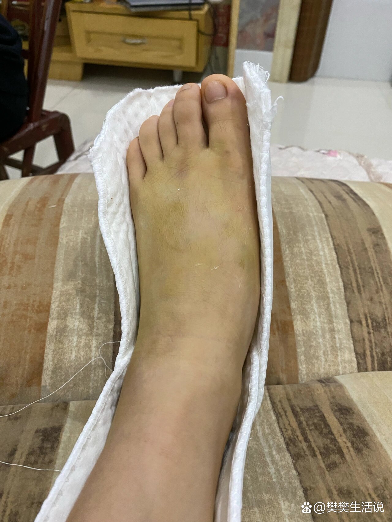 脚背骨折的第9天