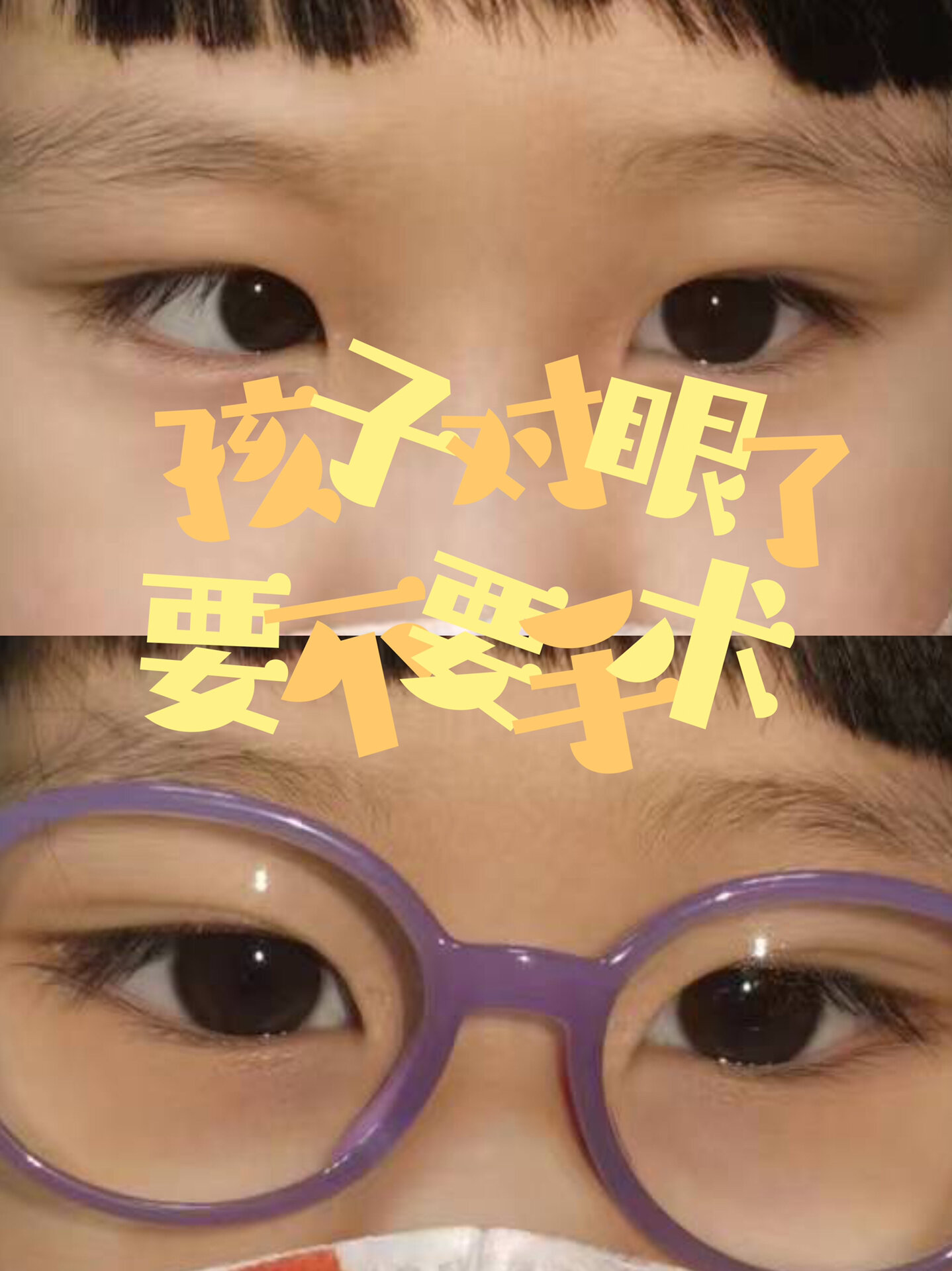 孩子"对眼"了,要不要手术?
