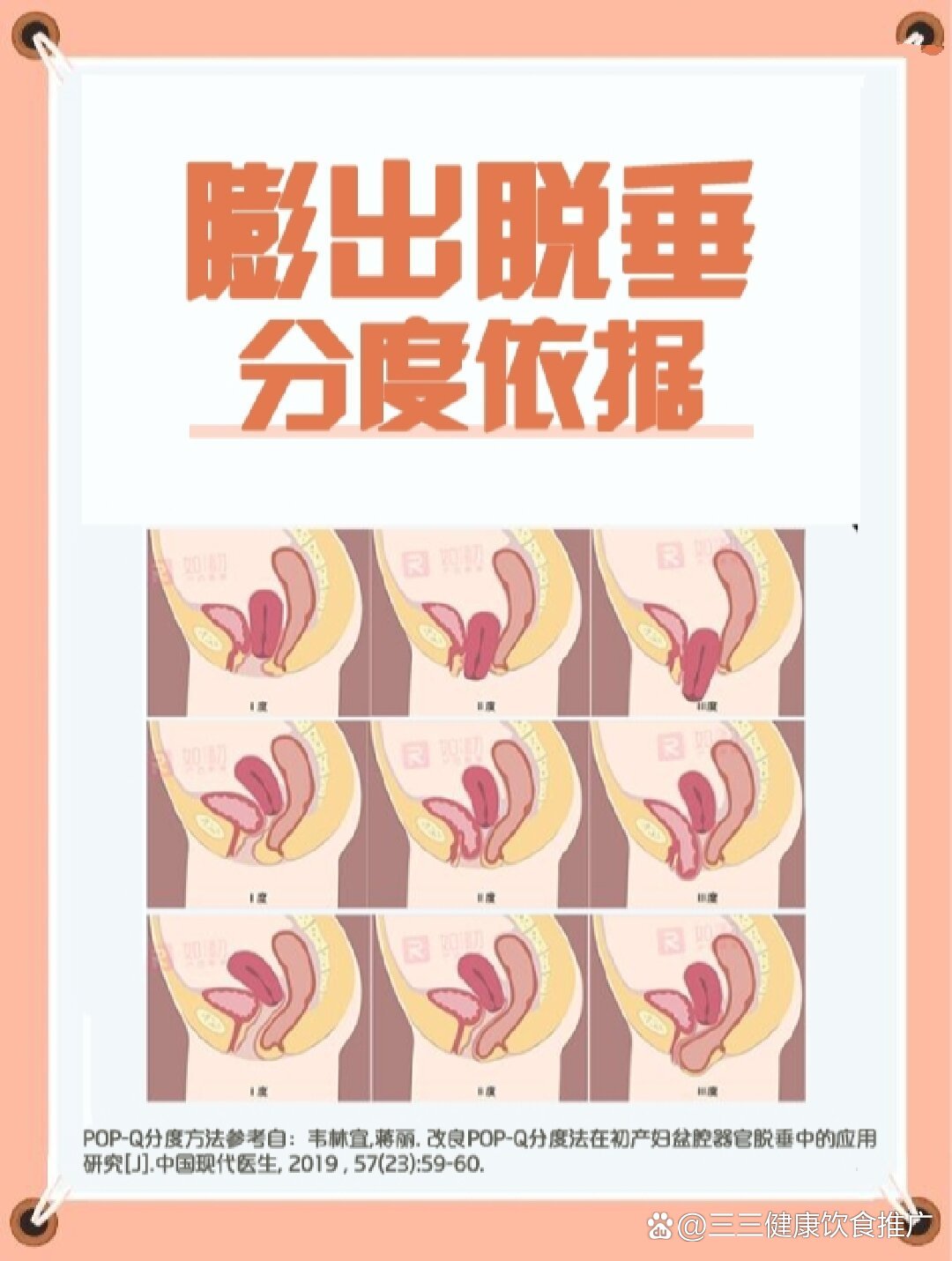 盆底小知识📒产后膨出脱垂程度判断方法