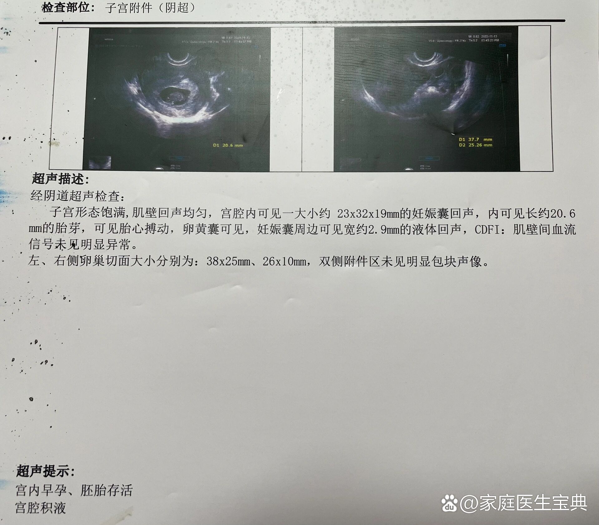 6有点低,彩超显示宝宝发育一切良好,还能看到有积液