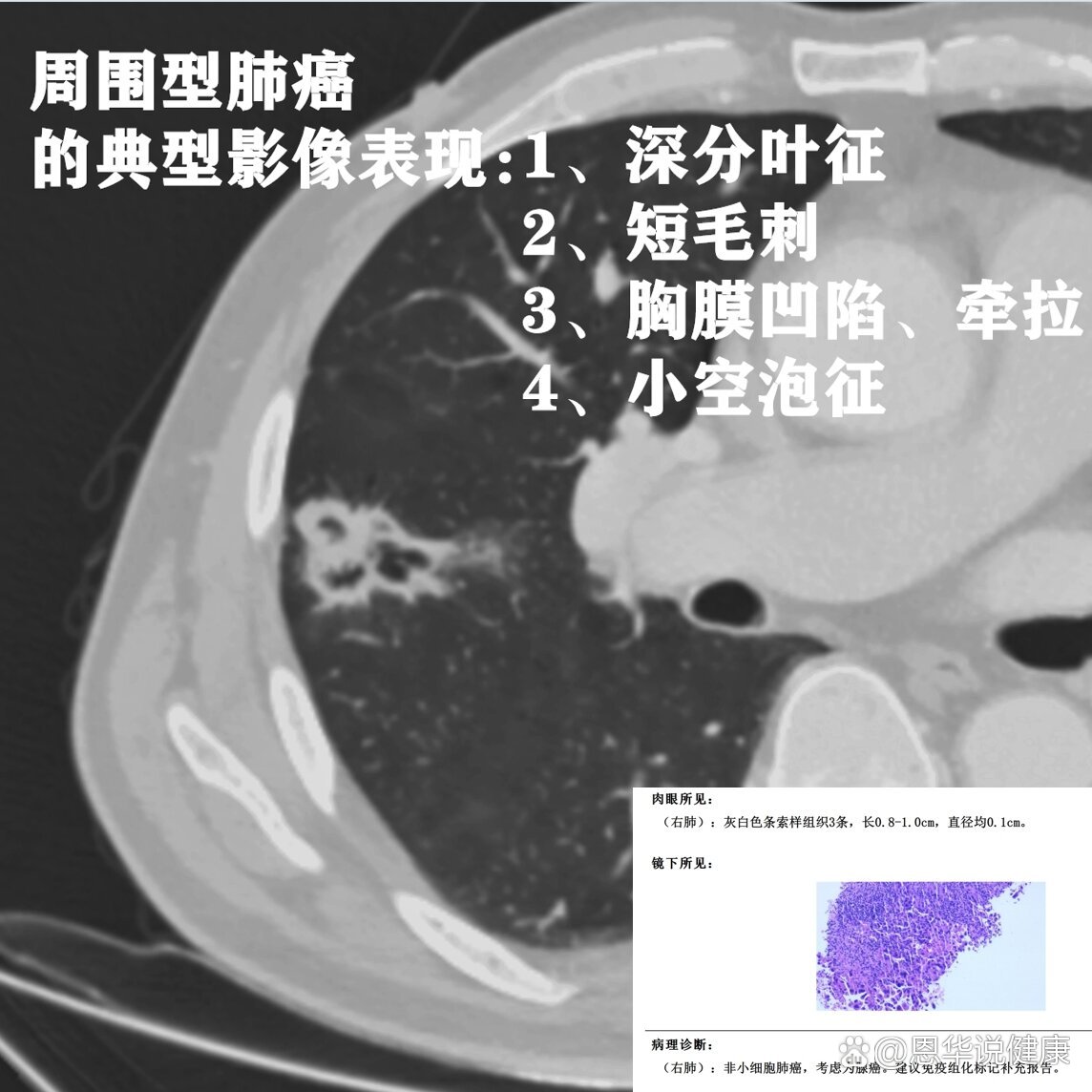 周围型肺癌ct图片图片