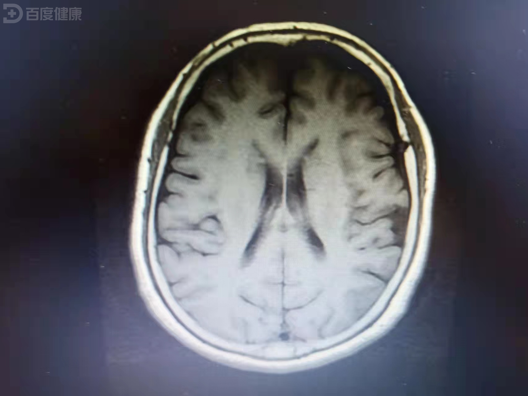 中年女性由于车祸,头部受到撞击导致出现脑震荡