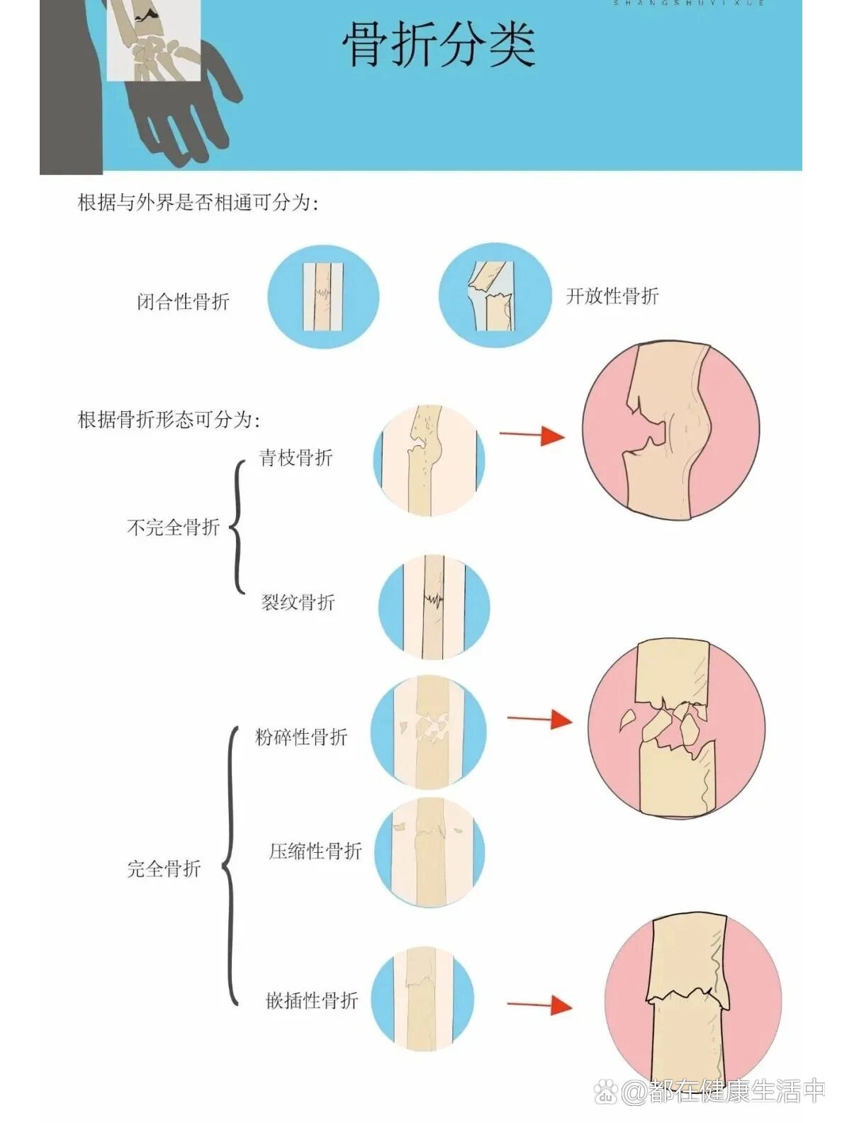 骨折的分类