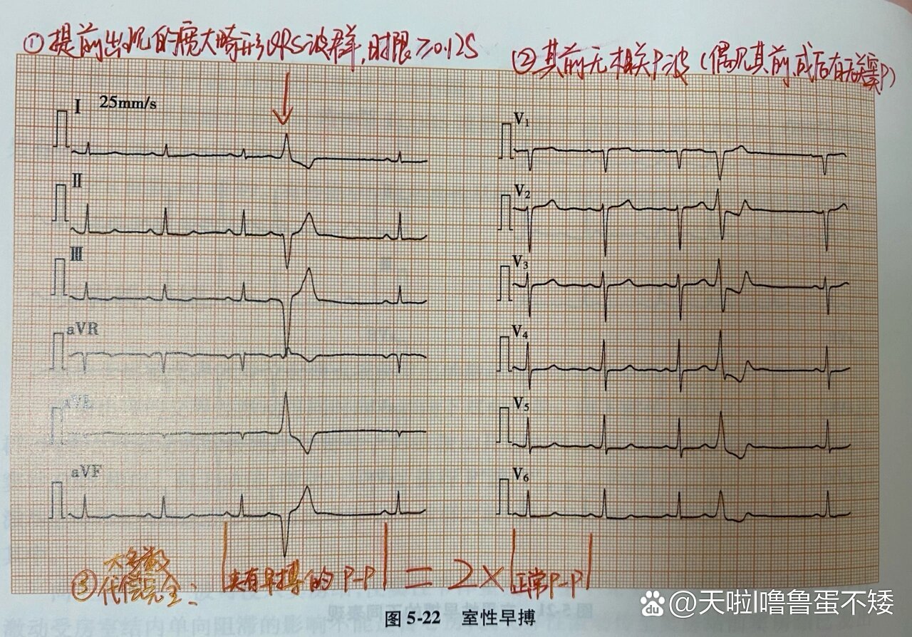 室性早搏典型心电图图片