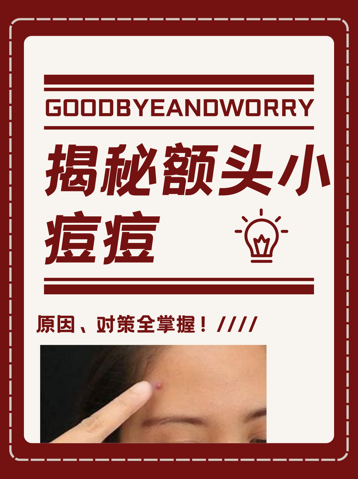 额头上长痘是因为什么