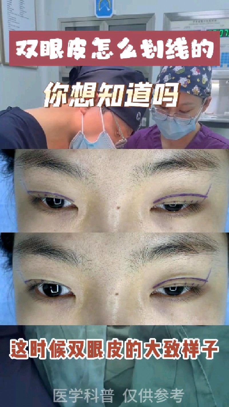 为什么做双眼皮手术前要划线呢?又该如何划线呢?