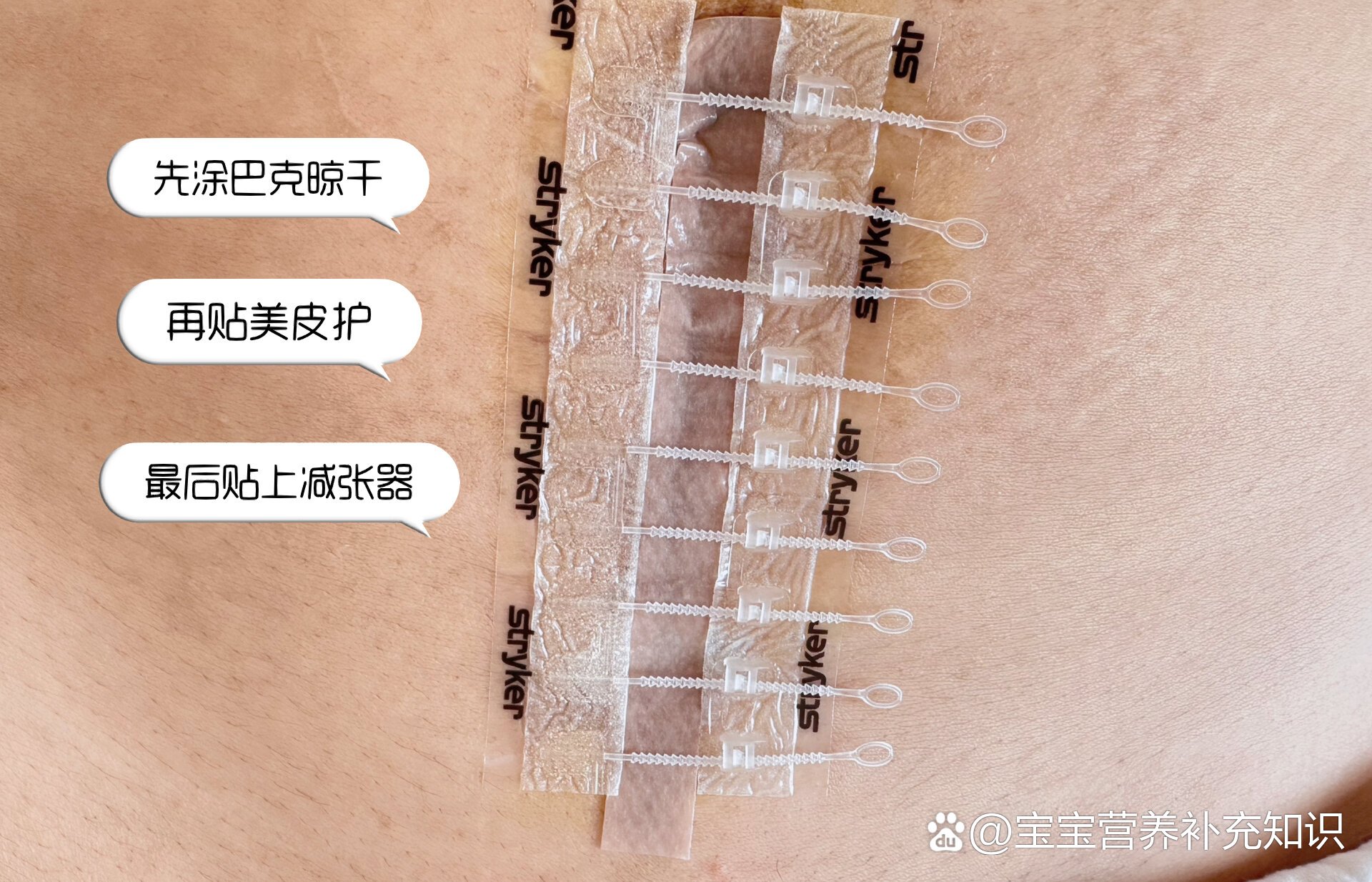 剖腹产怎么拆线图解图片