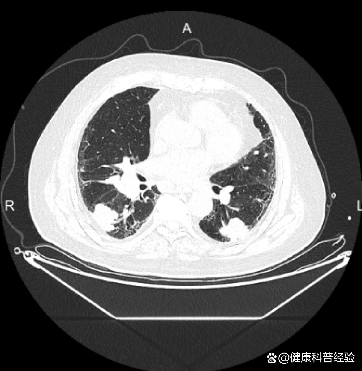 晚期肺癌影像学表现