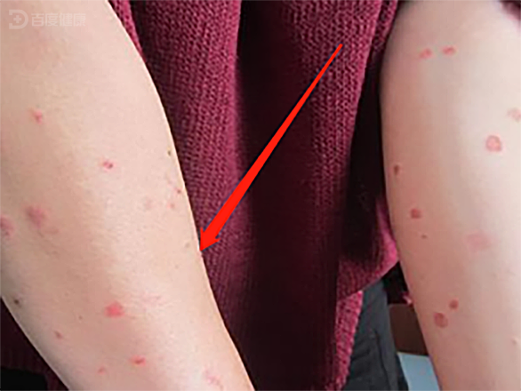 低下,躯干,四肢的皮肤上出现的豆粒大小红斑丘疹,躯干部皮疹融合成片