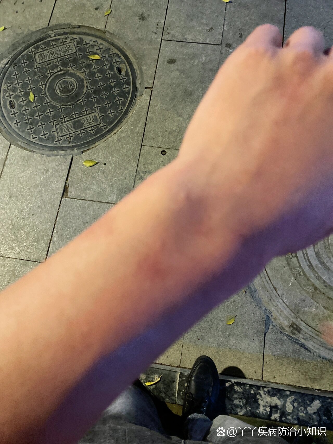 兄弟们喝了酒身上起红斑怎么解决