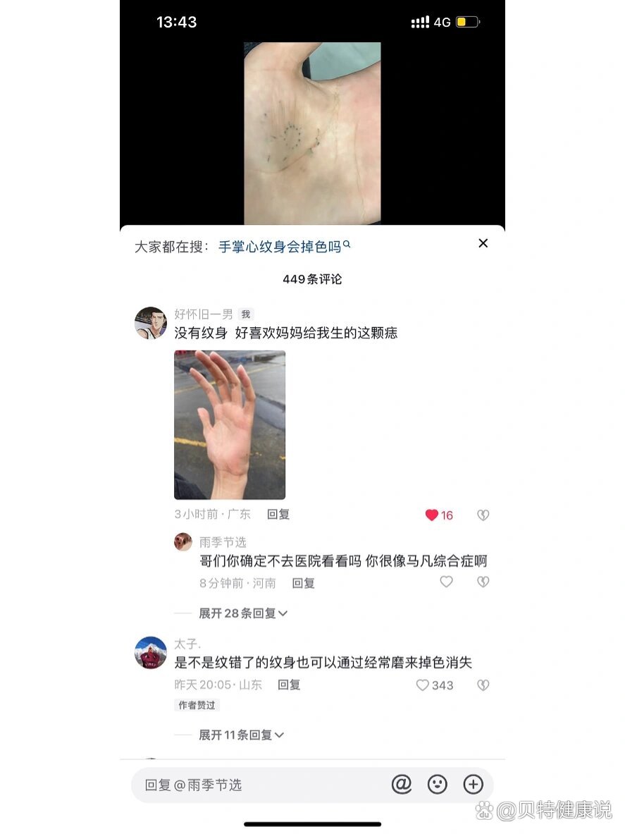 马凡氏综合症自测图片