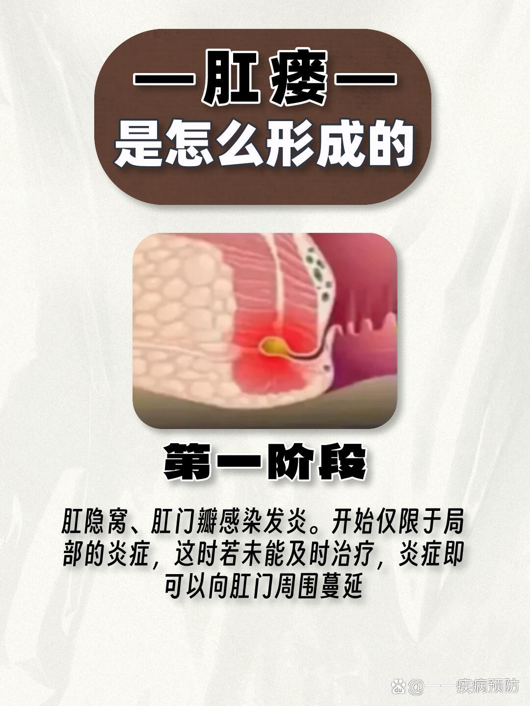 肛窦炎怎么治疗图片