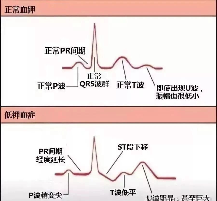 低钾血症的心电图特征图片