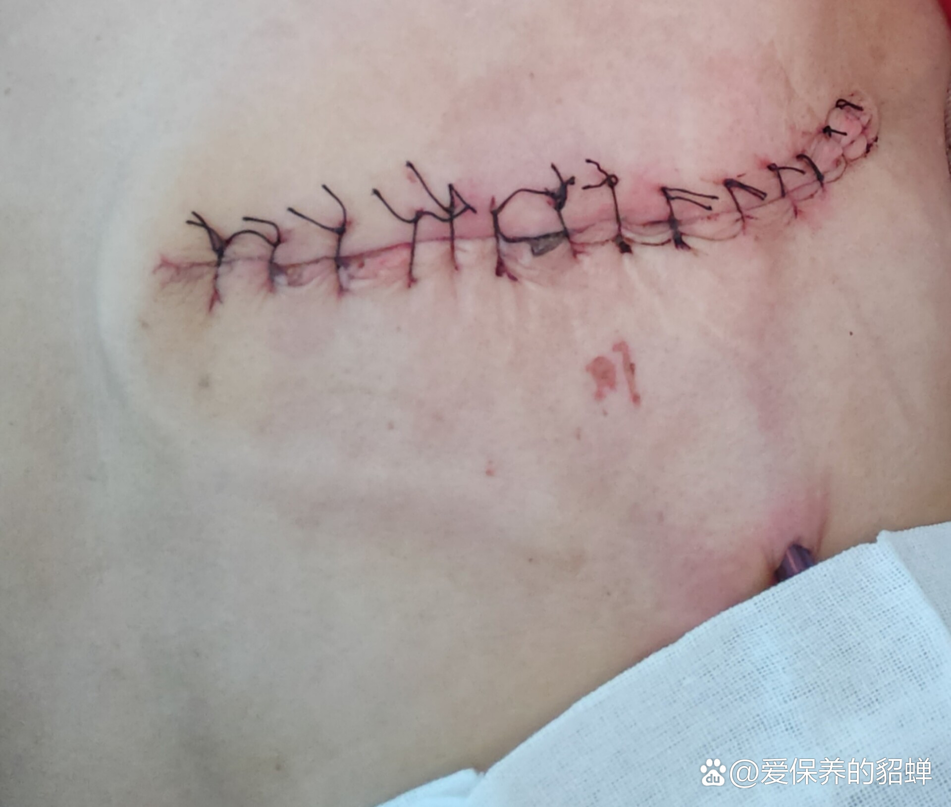 乳腺全切要如何去疤