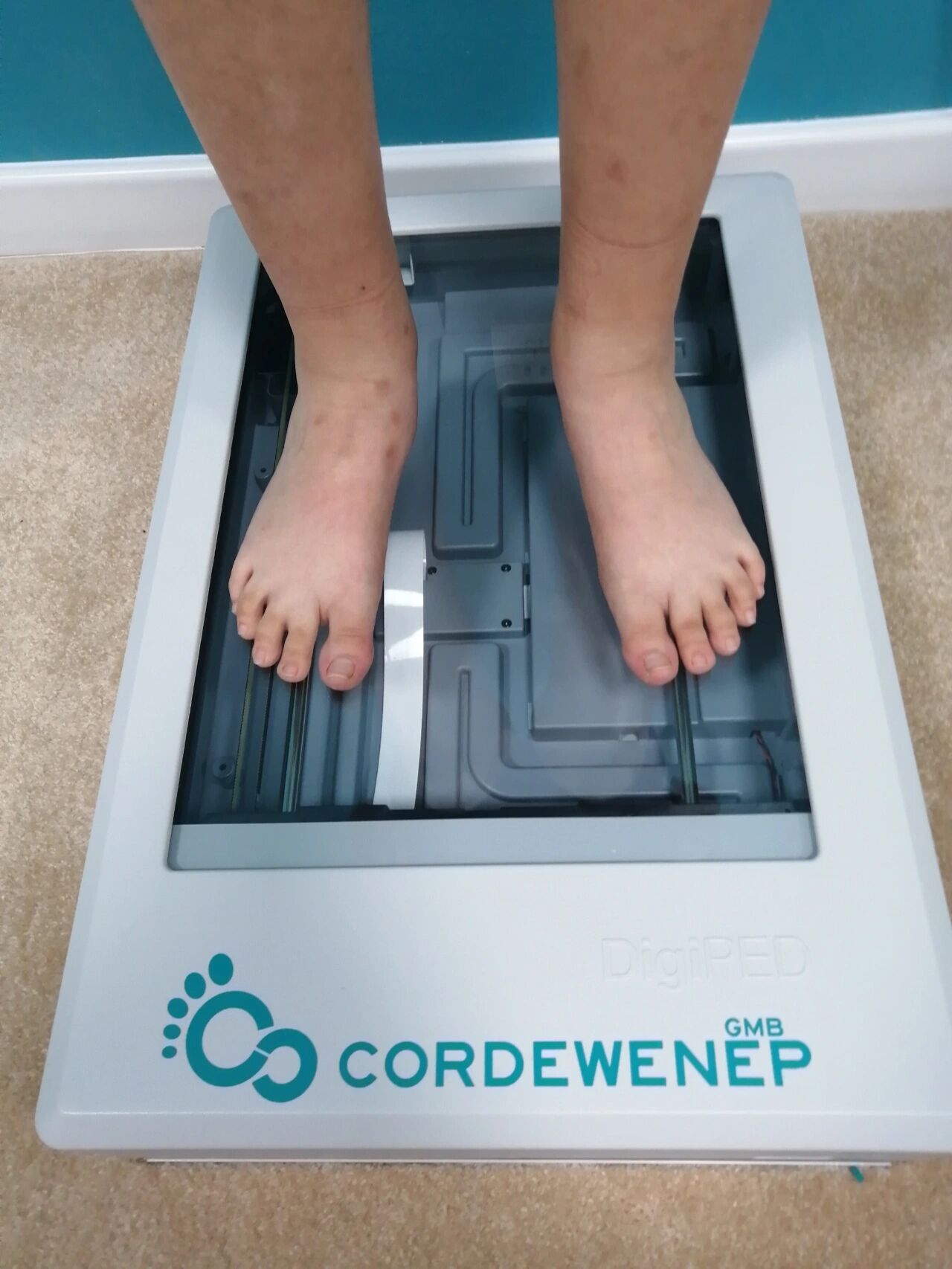 副舟状骨是指正常舟状骨内侧结节处的一块副骨,是一种常见的先天性舟