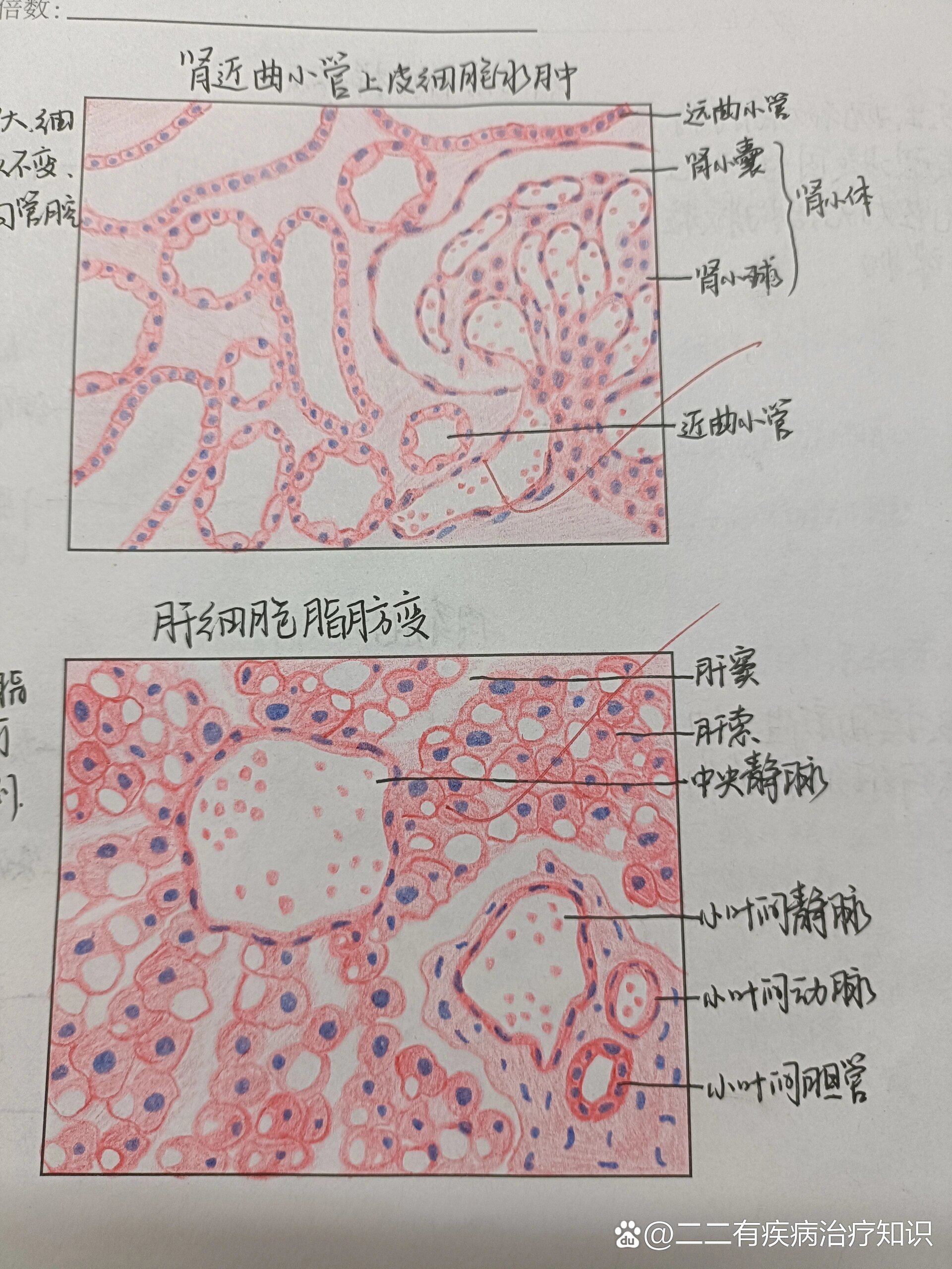 p 病理学红蓝铅笔绘图 br   br p3 慢性肺淤血心衰细胞要再画大一点