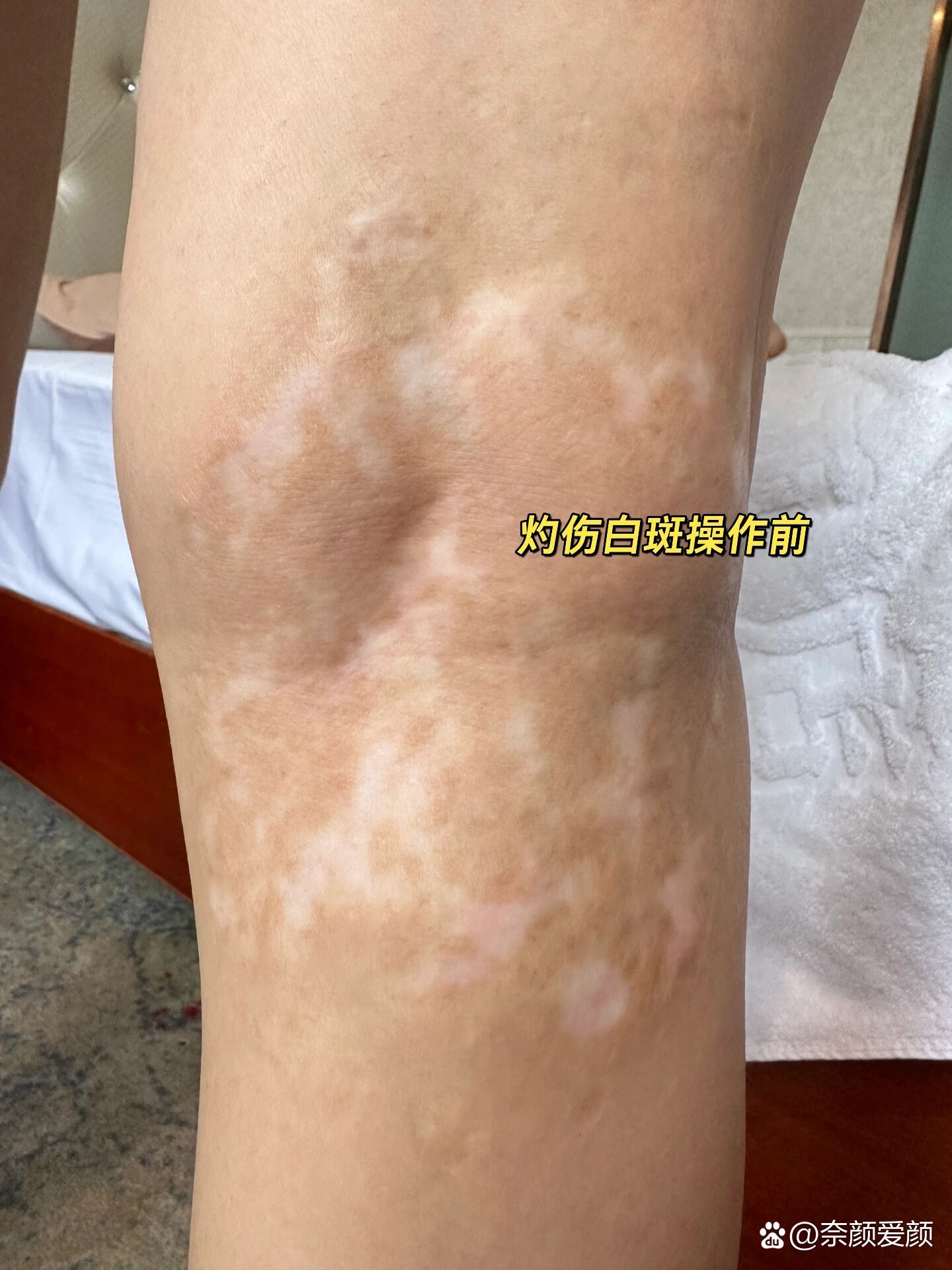 白斑,白疤肤色重建六天对比