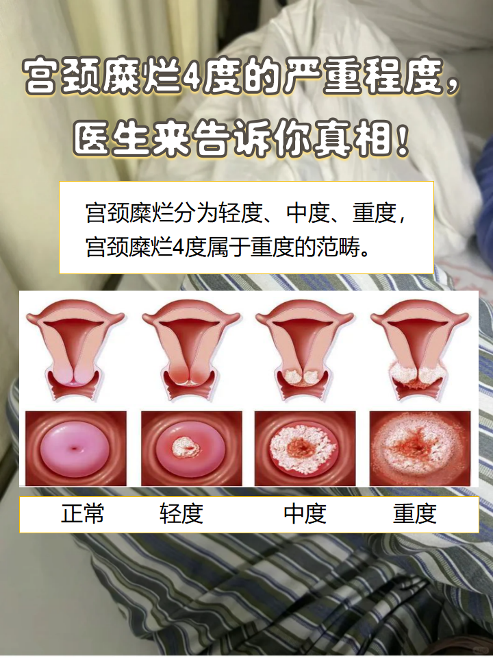 宫颈糜烂4度的严重程度,医生来告诉你真相!