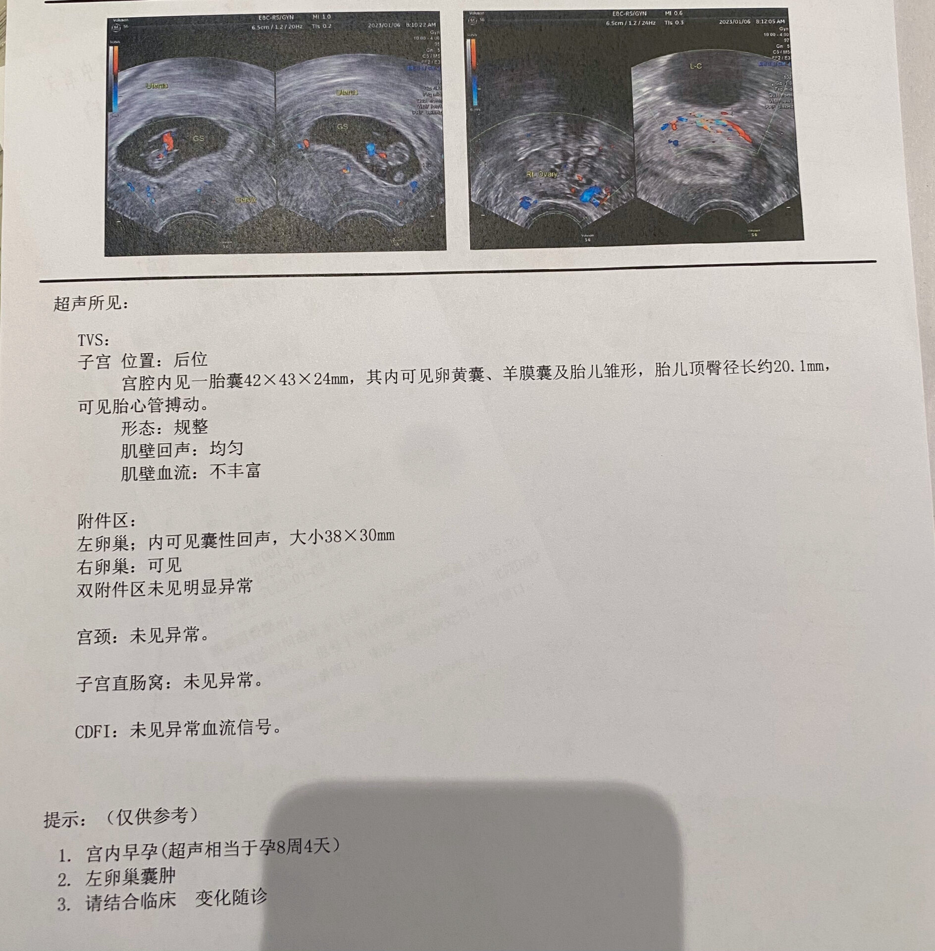 阴超 怀孕图片