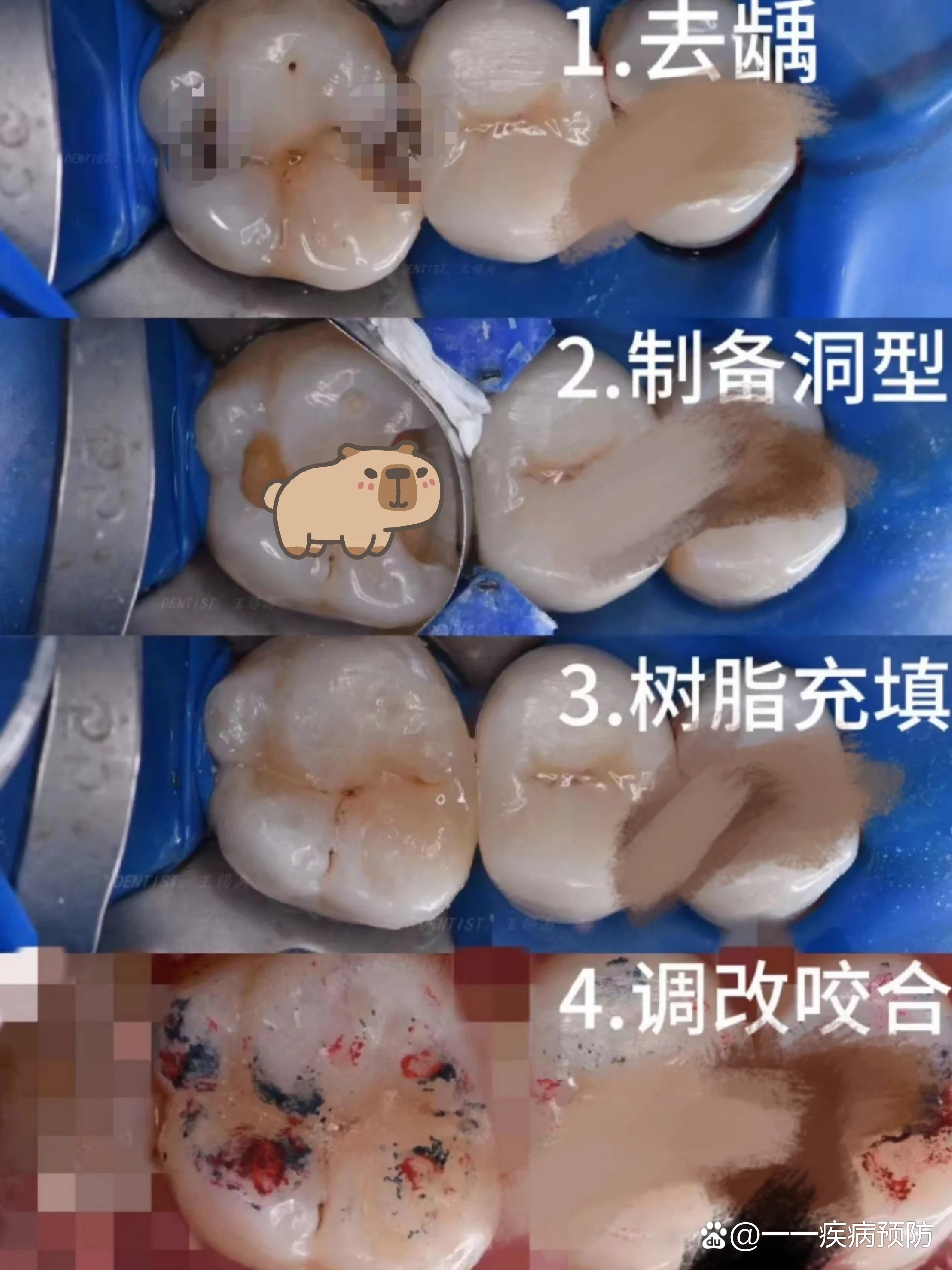 补牙的操作流程以及如何正确使用器械和车针