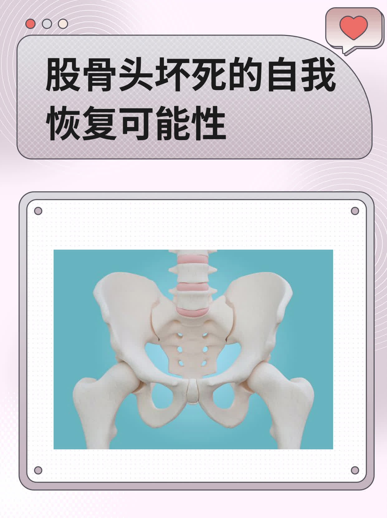 股骨头坏死的自我恢复可能性