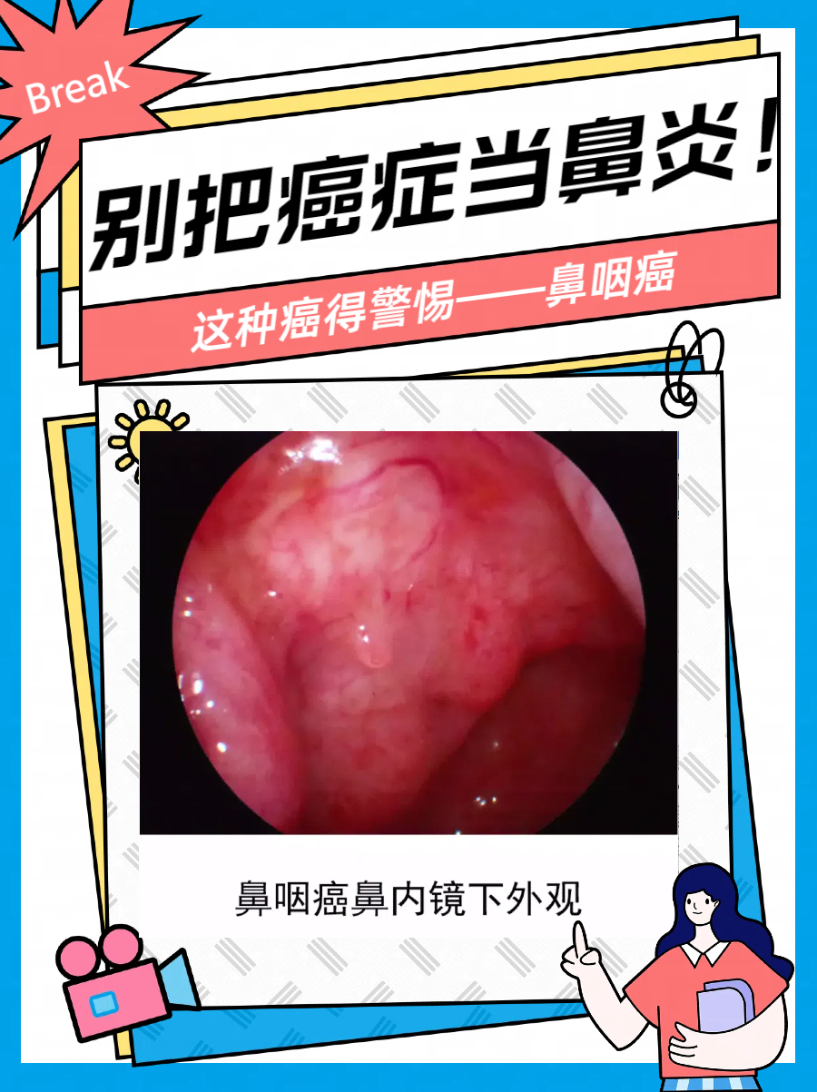 鼻咽癌≠鼻炎!鼻咽癌你必须知道的二三事