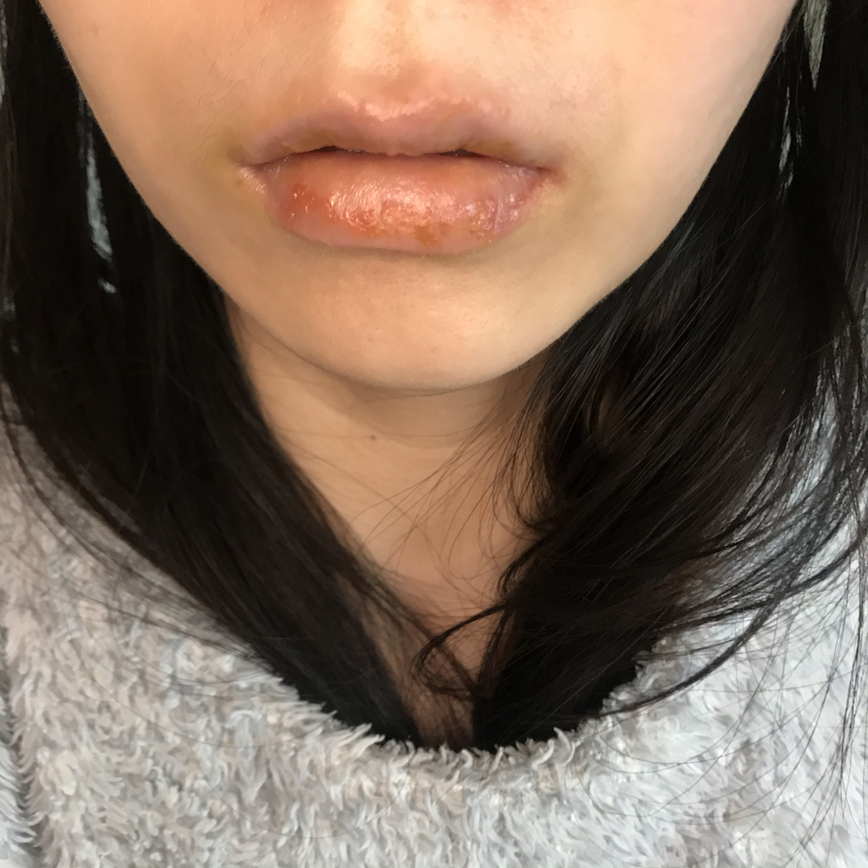 过敏性唇炎治好了