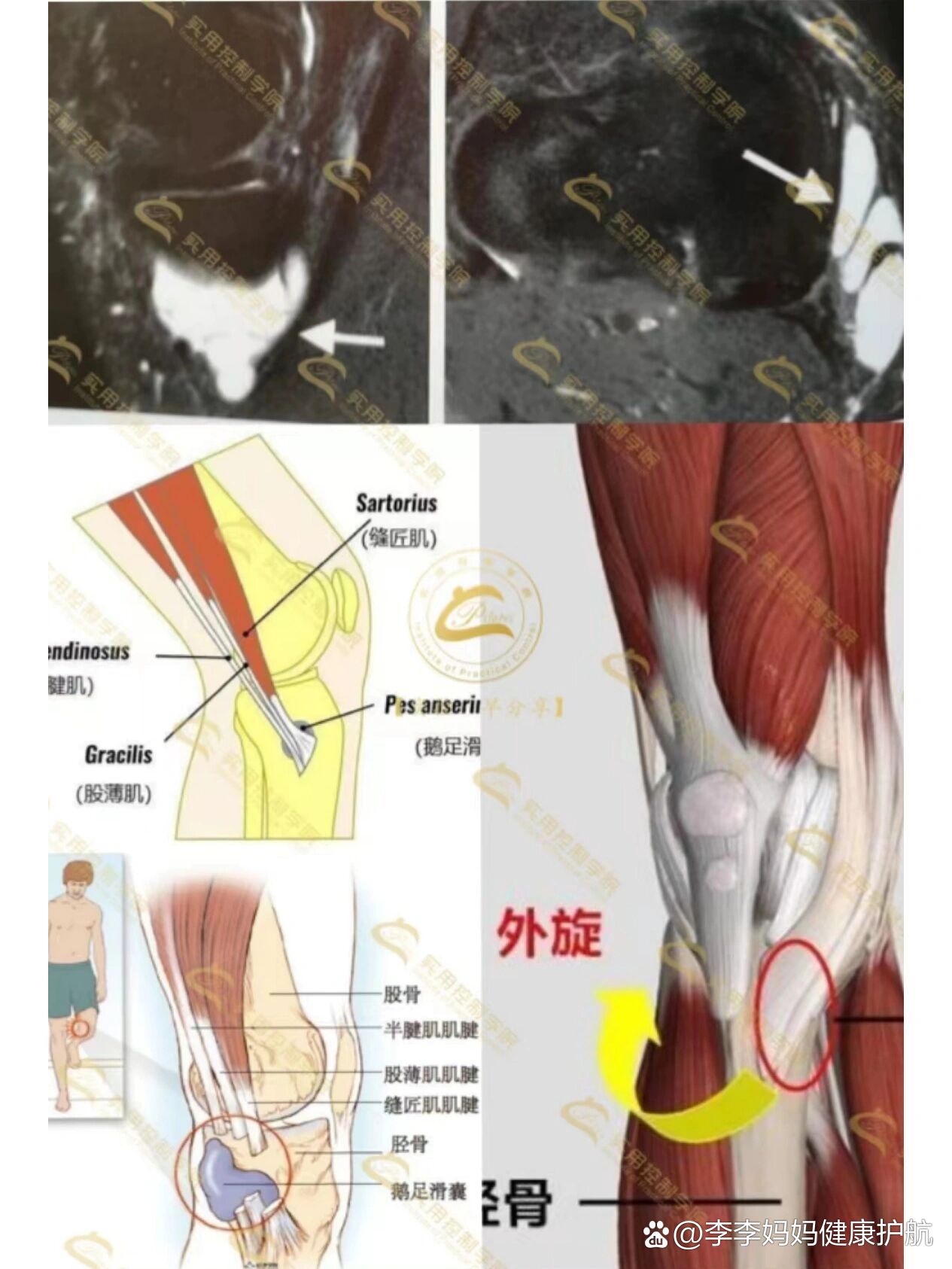 鹅足腱滑囊炎怎么治疗图片