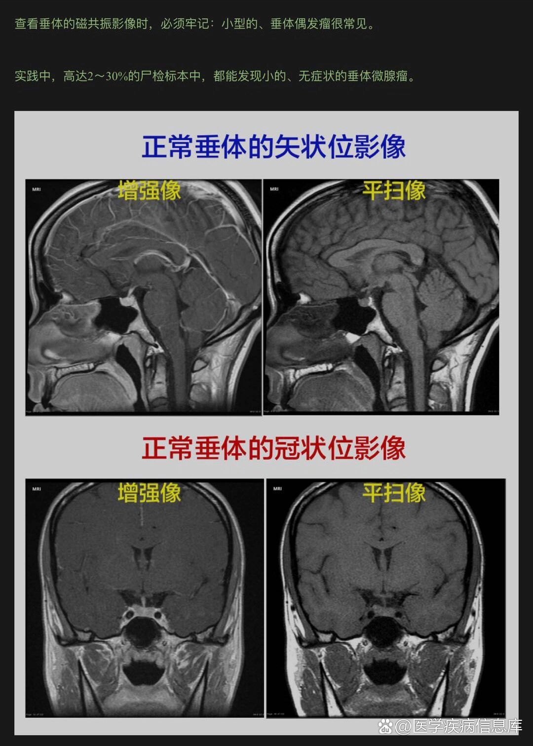 垂体瘤标本实物图片