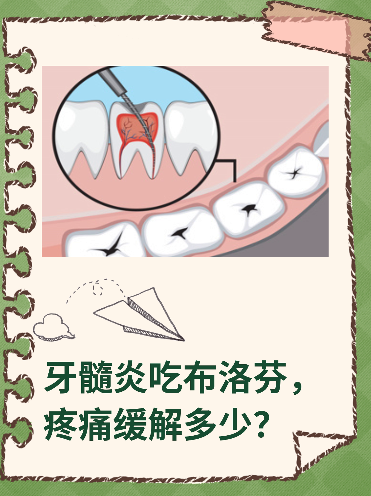 牙髓炎吃布洛芬,疼痛会缓解吗