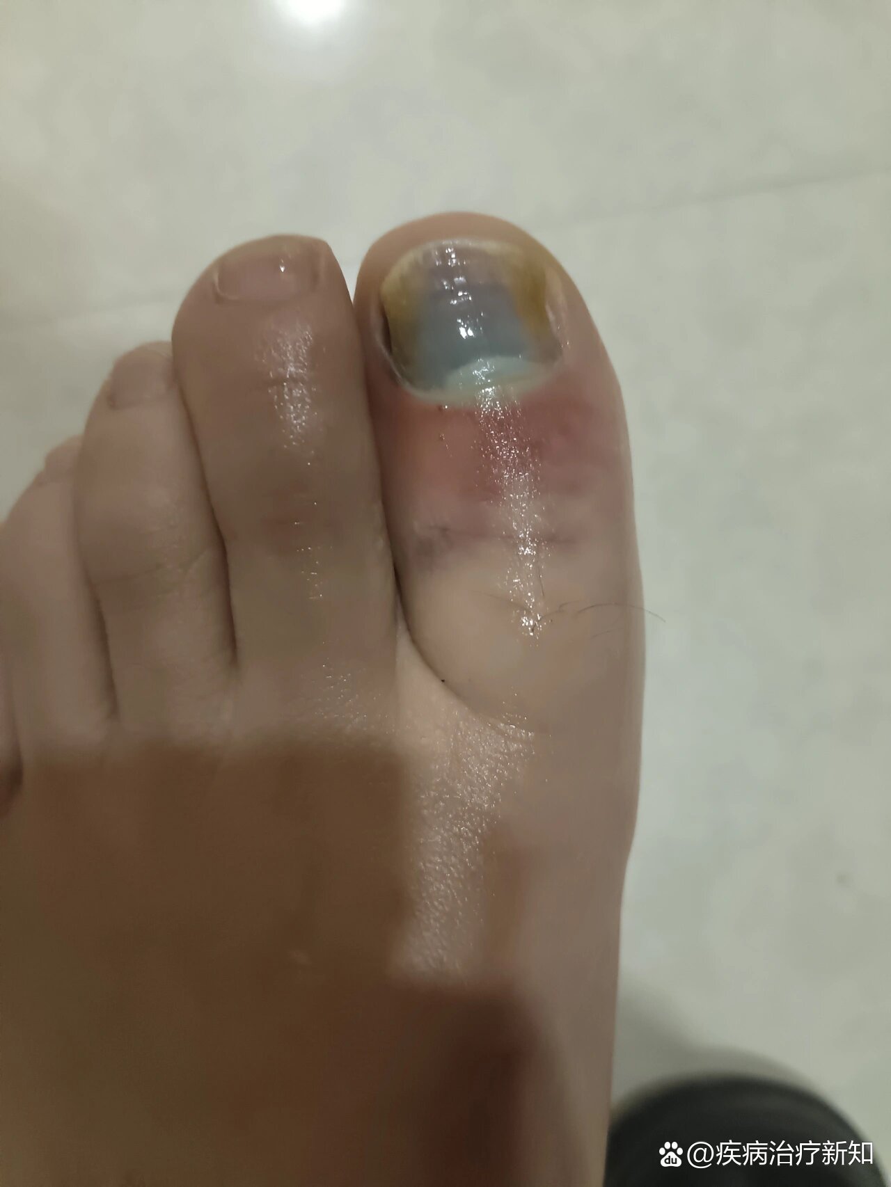 脚趾头被桌子砸到了,好痛!