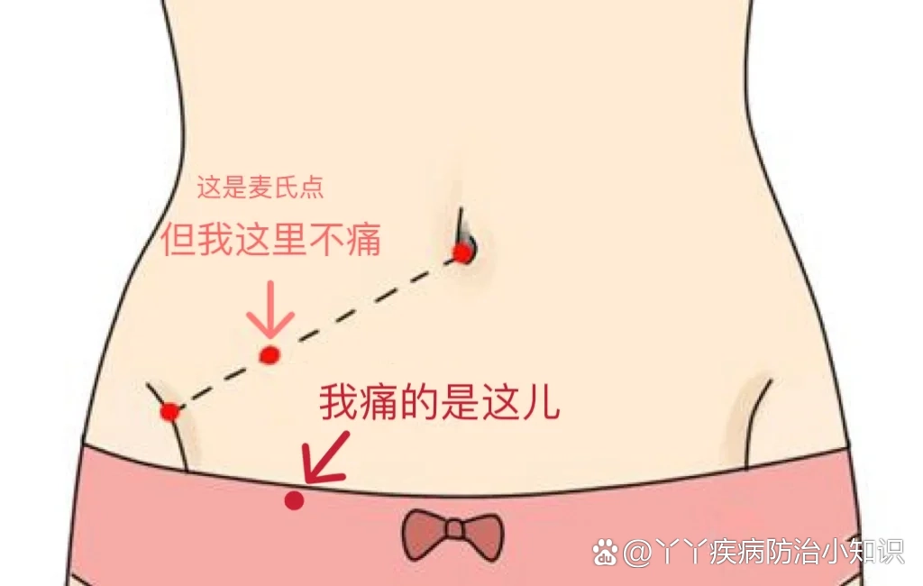 右下腹隐痛确诊慢性阑尾炎