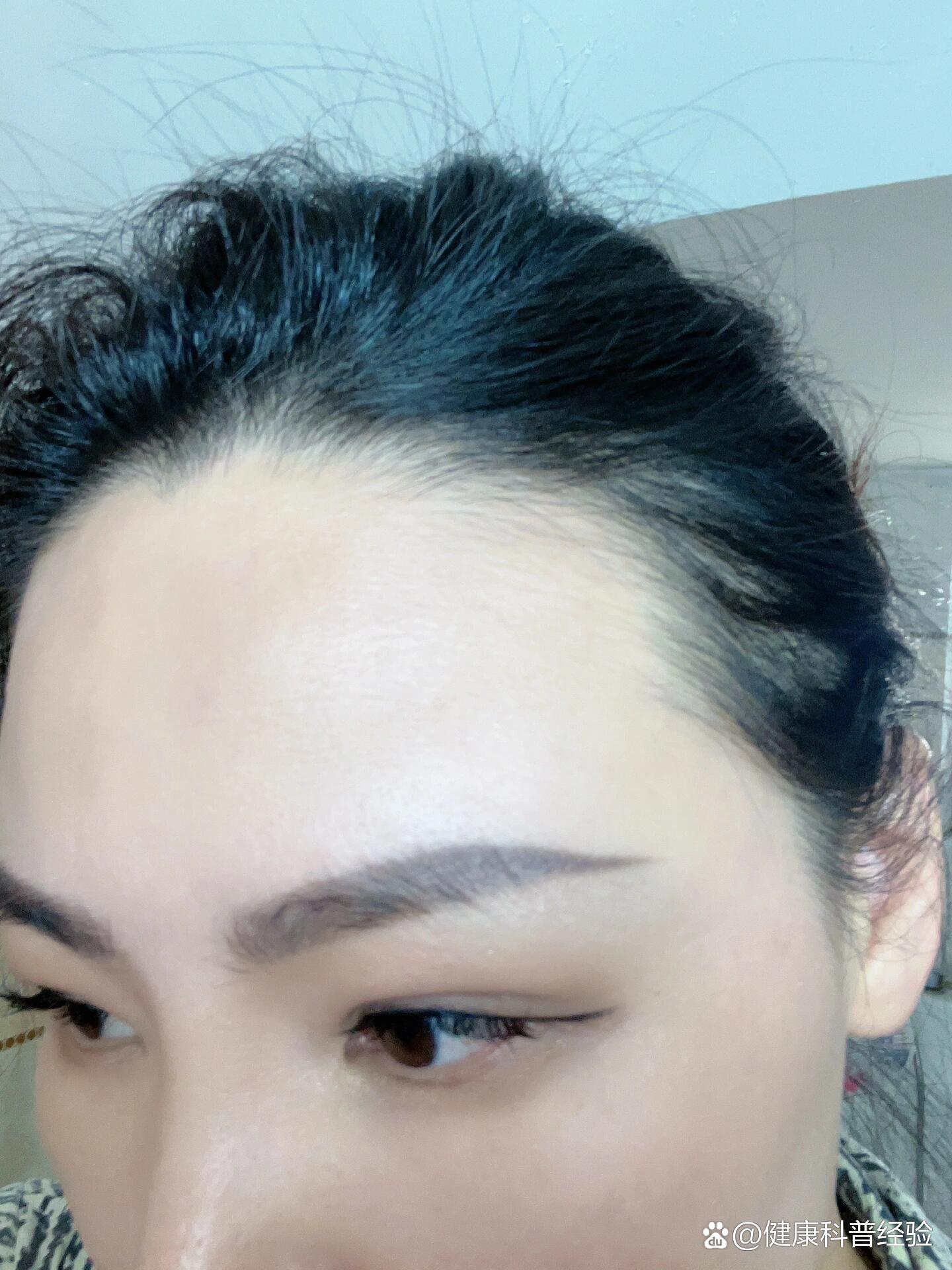 到今天生物素吃了正好三个月!前额的头发还可以长出来一些小绒毛!