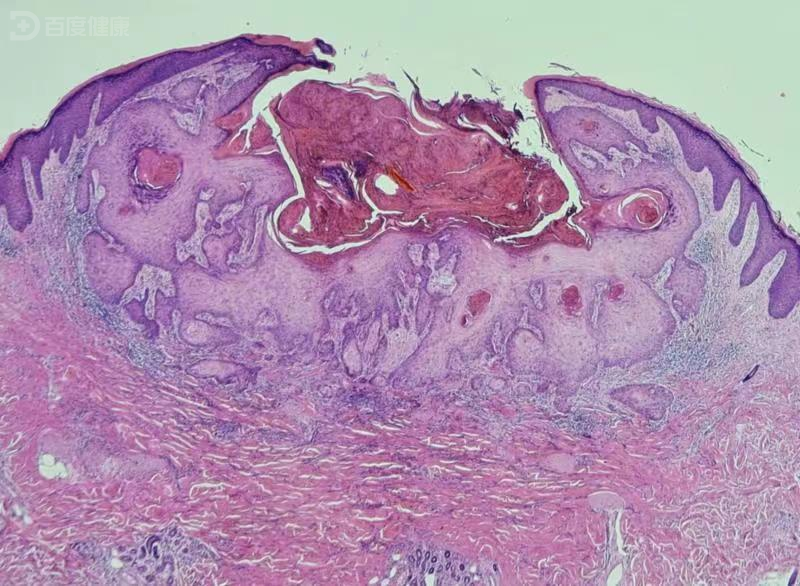 角化棘皮瘤一般不会威胁患者生命安全