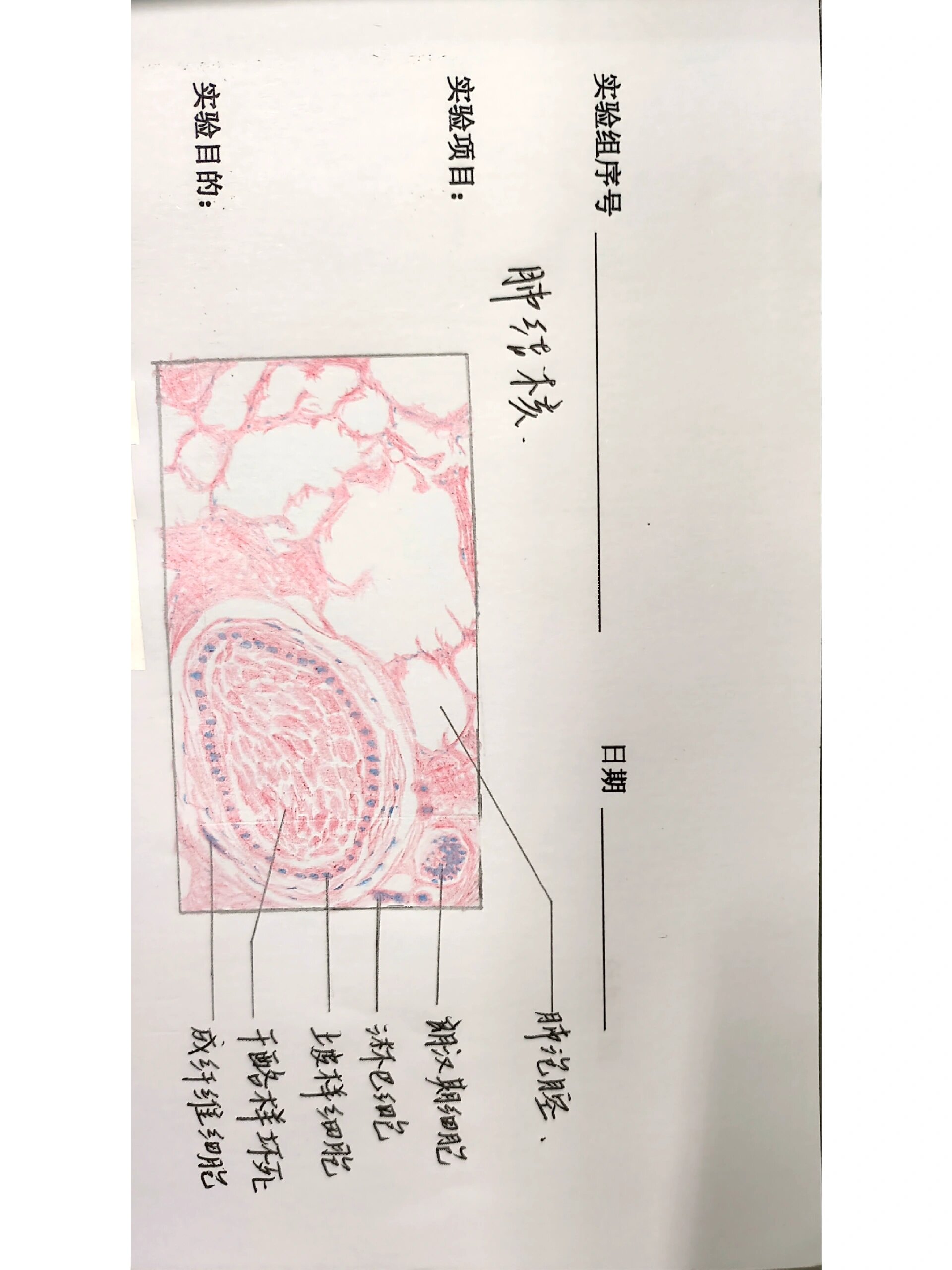 结核结节病理手绘图图片