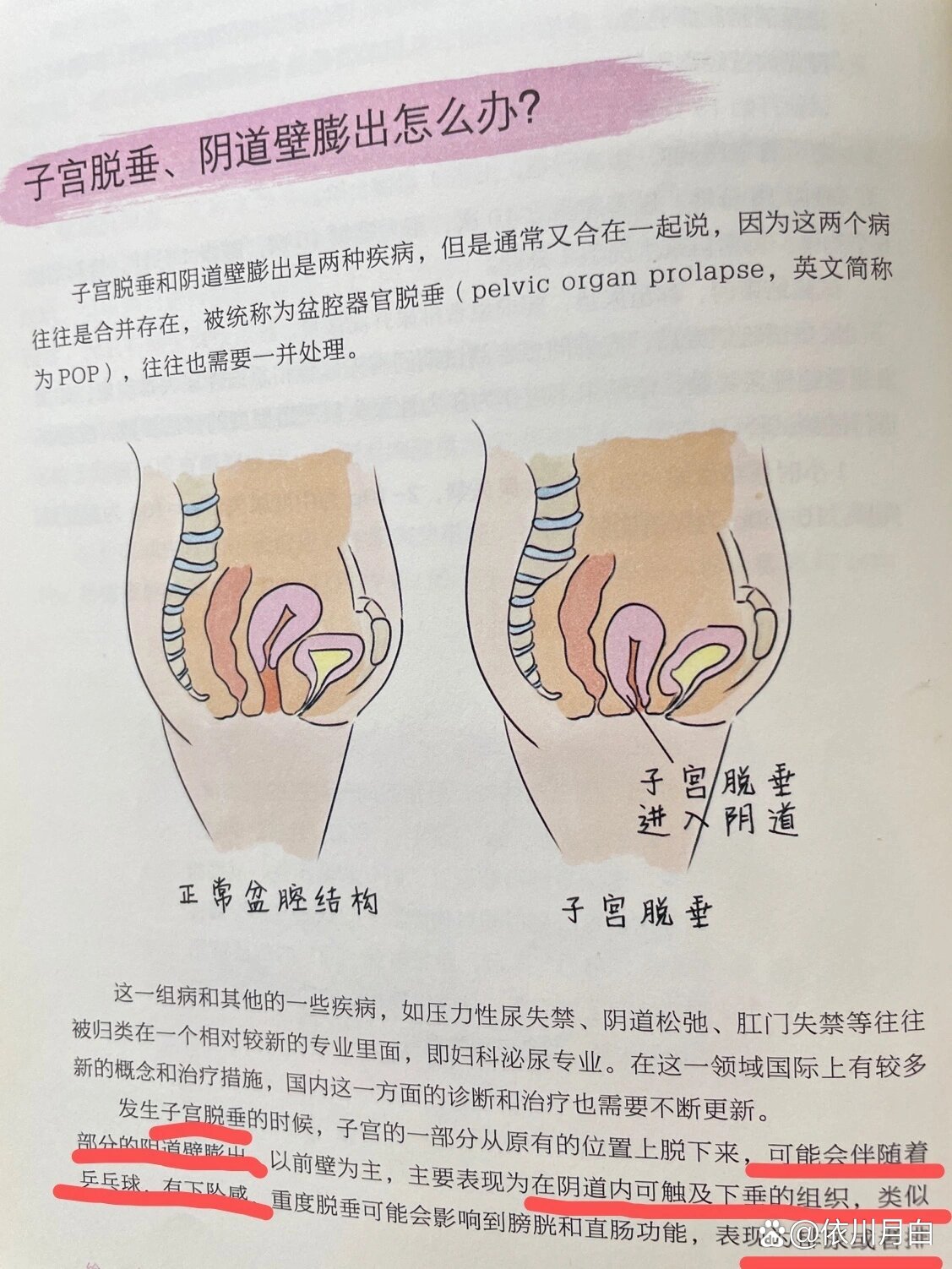 子宫脱垂,阴道壁膨出?