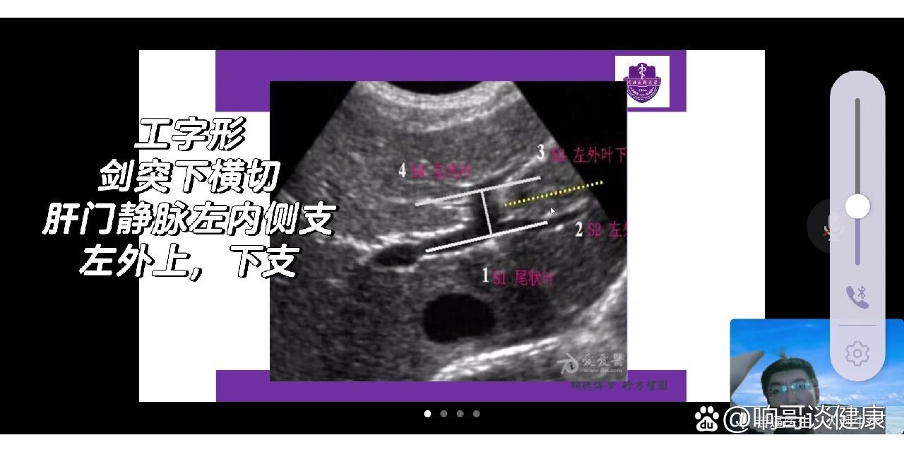 肝脏超声1(工字形,第一肝门,第二肝门)