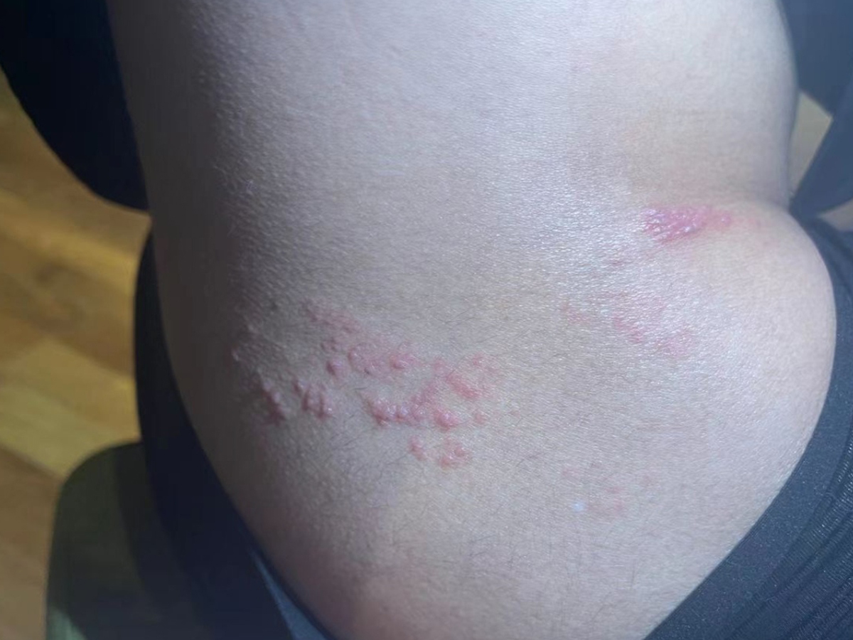 28岁小伙患蛇串疮,腰部疼痛,小水疱给出信号!