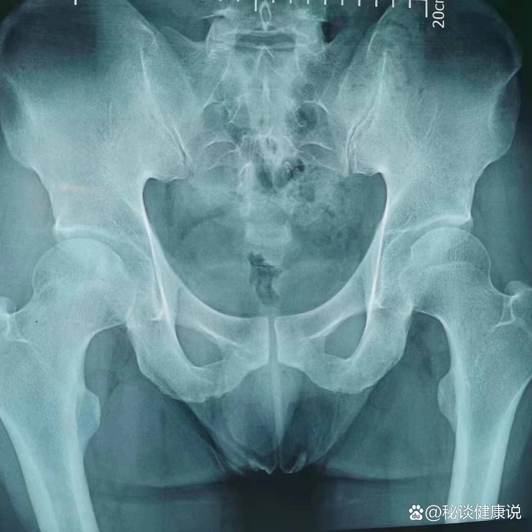 股骨头坏死片子