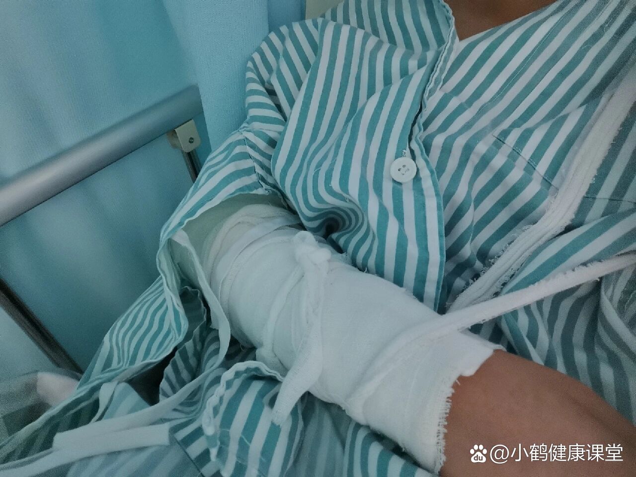 左手桡骨小头骨折