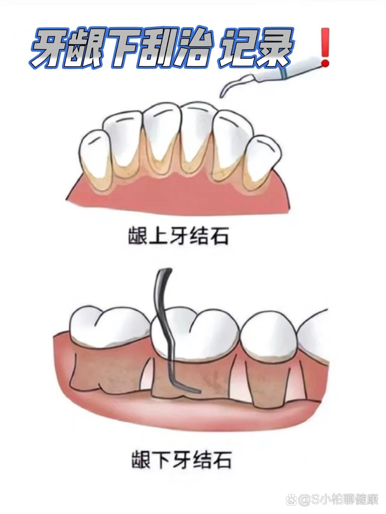 刮治器怎么区分图解图片