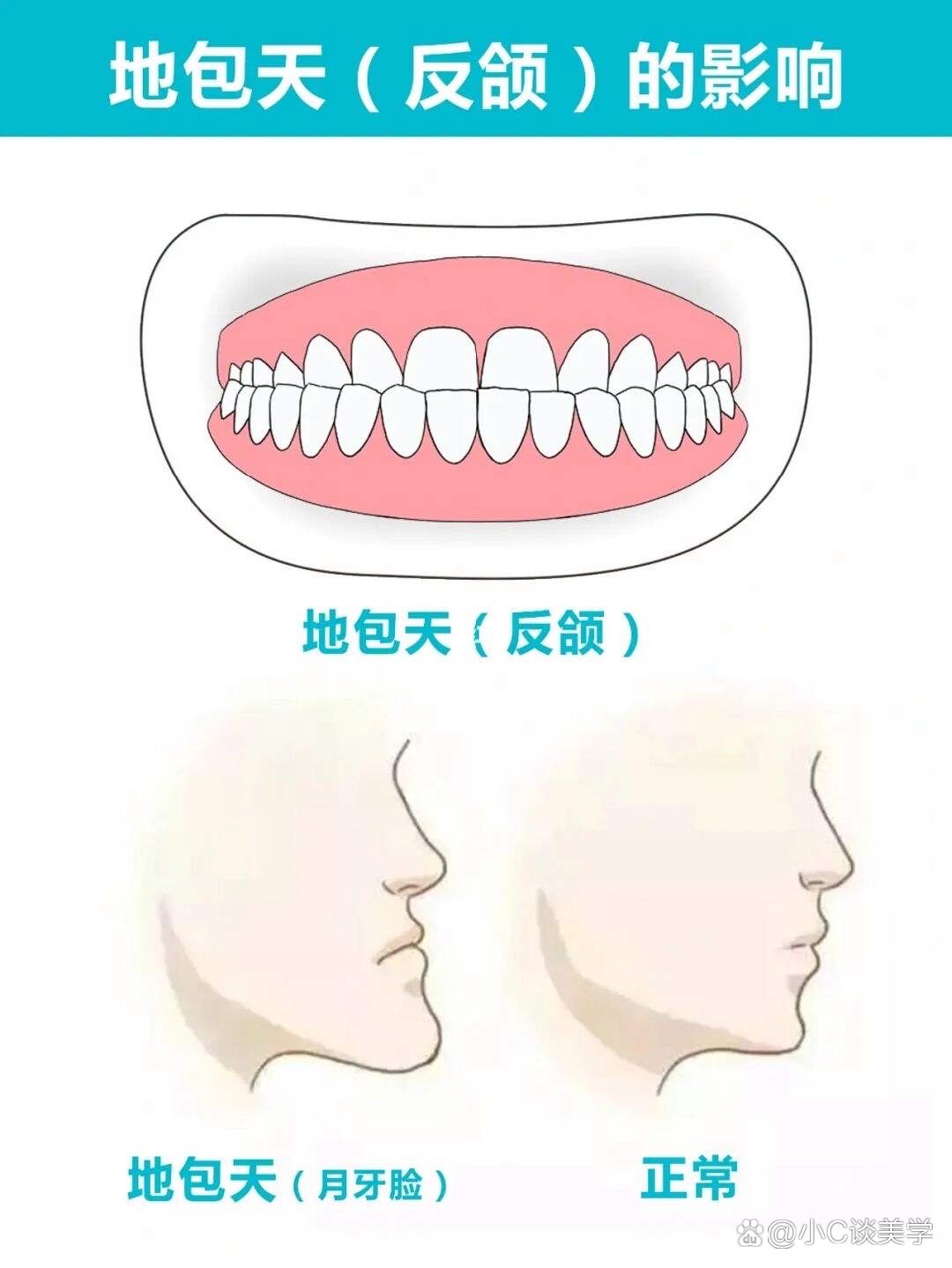 反颌是什么？