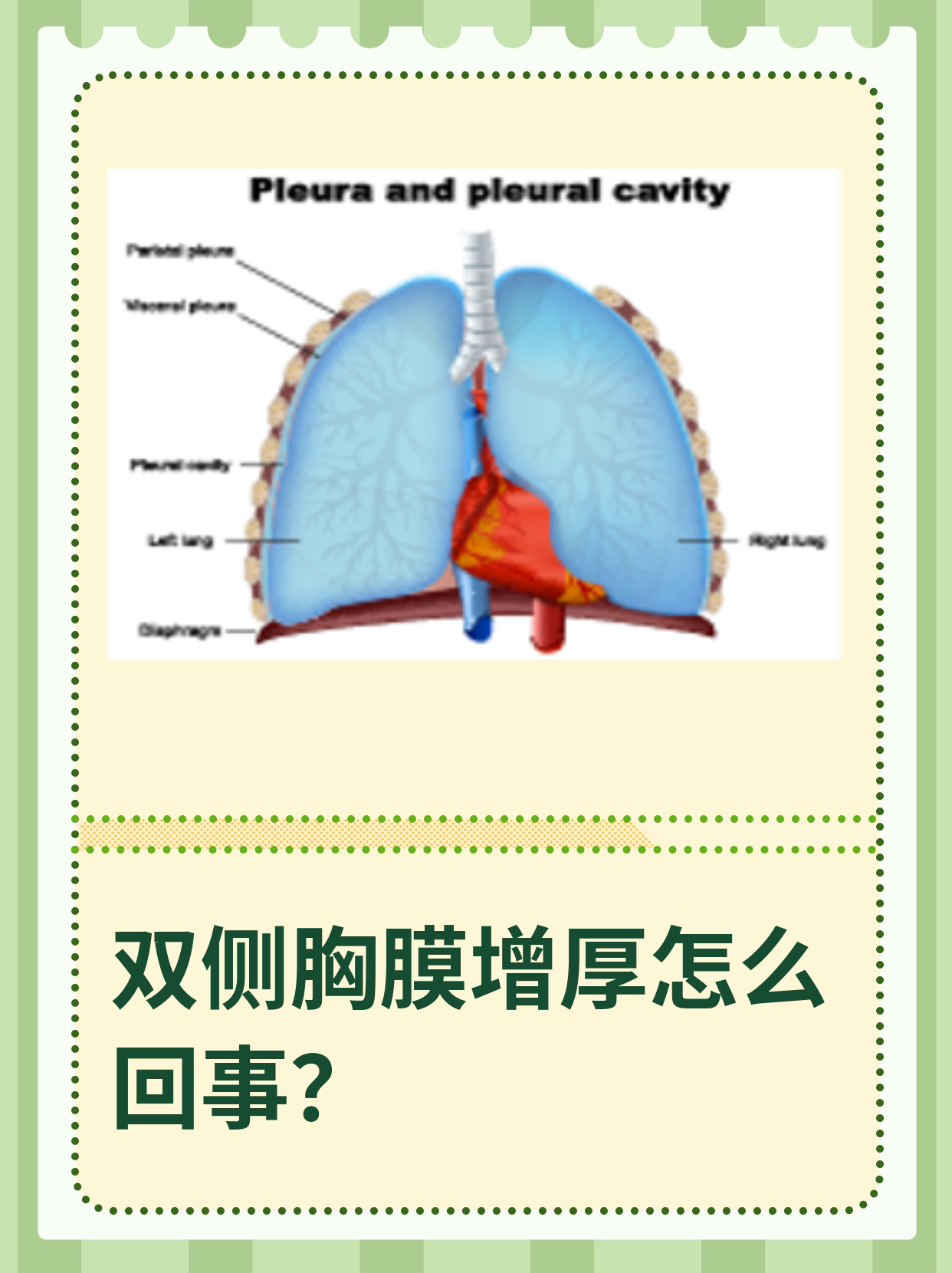 胸膜增厚图片