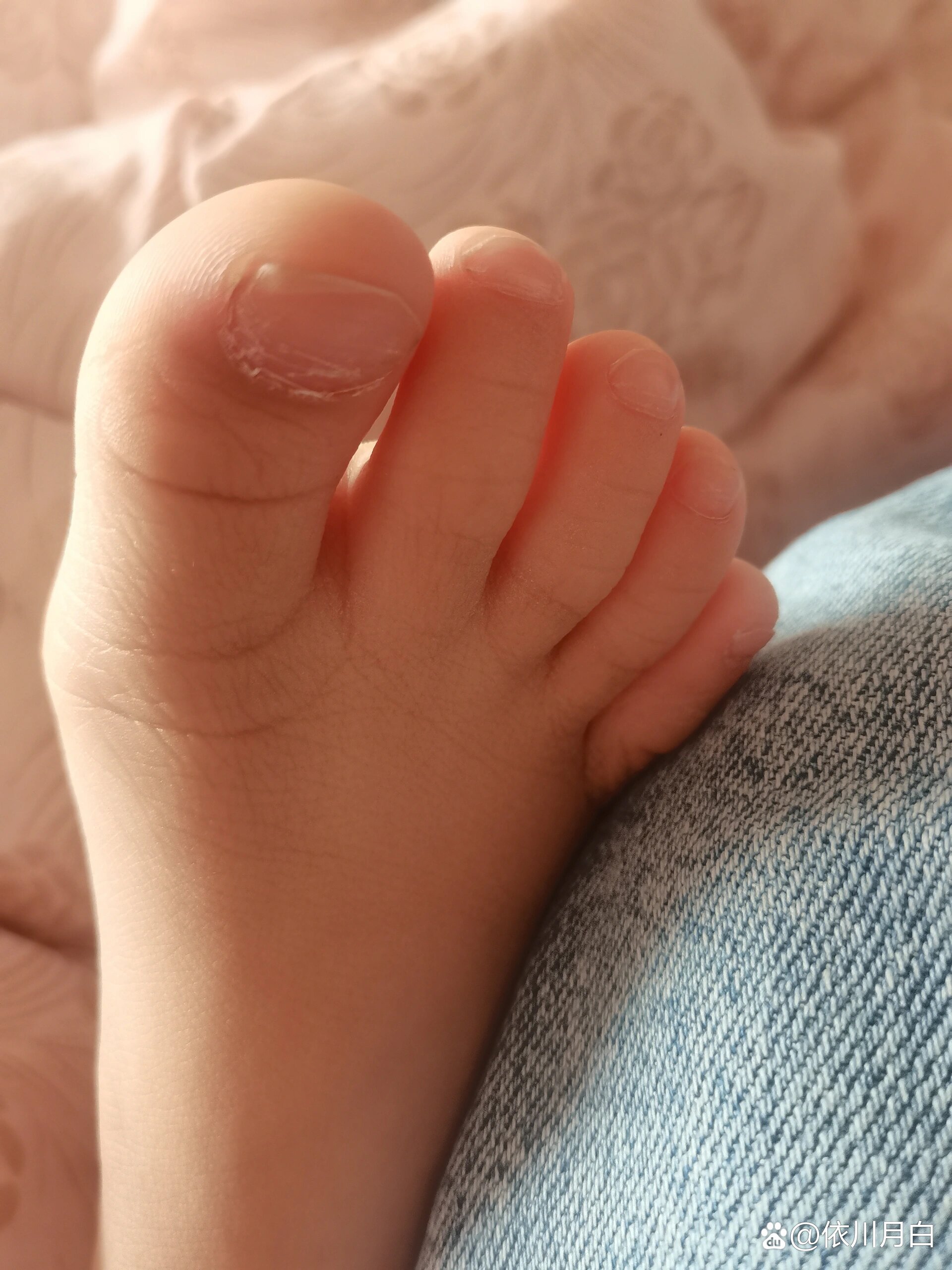 这个脚指甲怎么一层层的,大母脚趾最严重,查看小红书有说是灰指甲,有