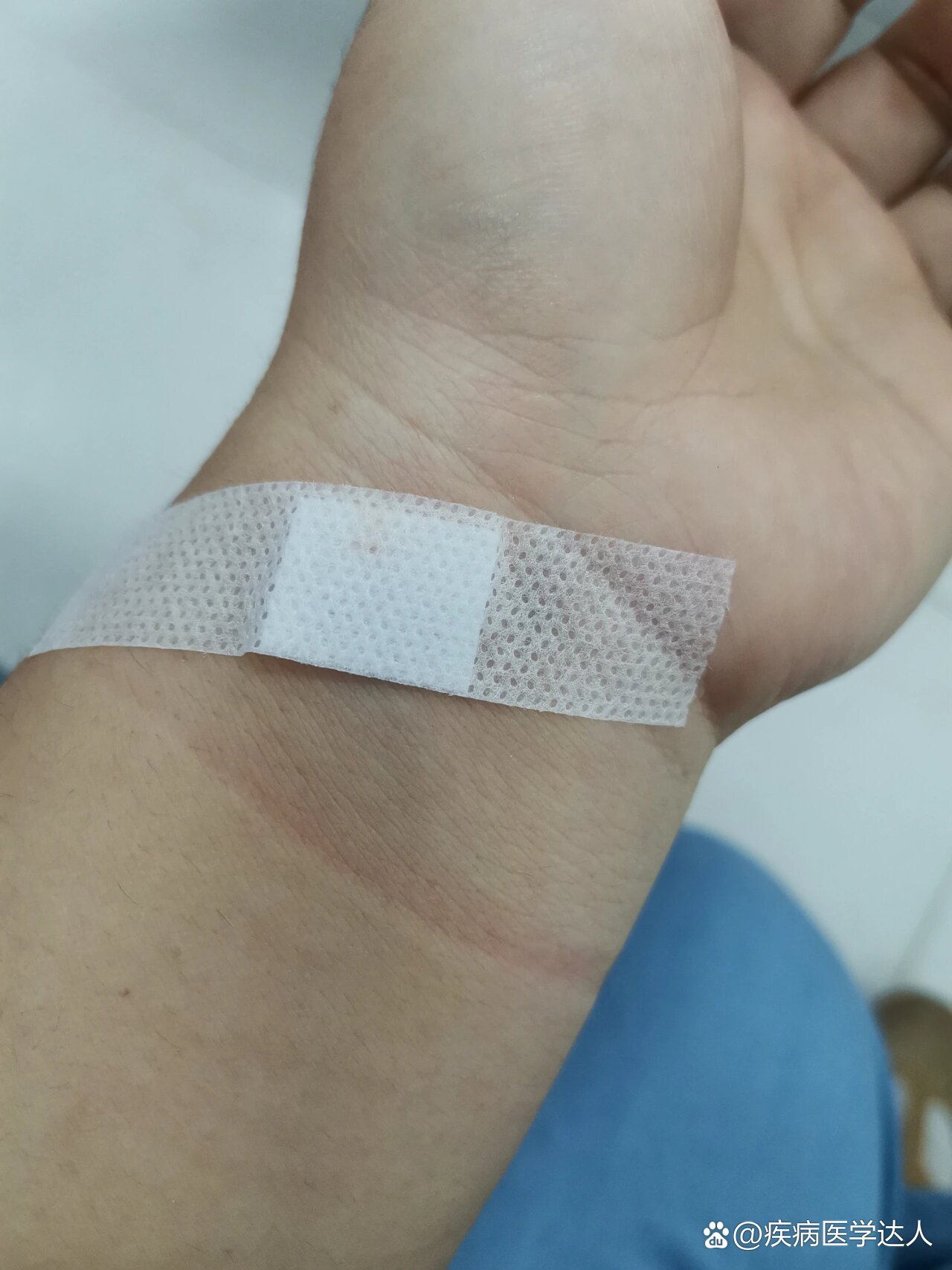 了昨天挨了三针打到了今天挨三针没找到血管最后一次给我扎的手腕